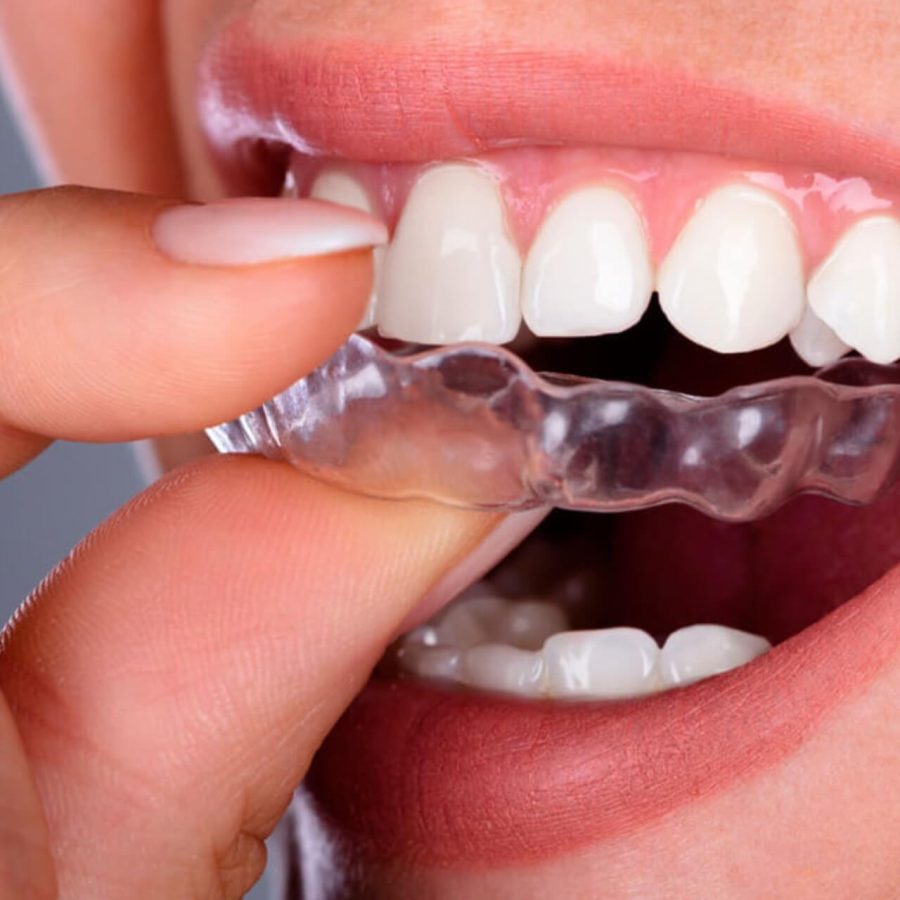 invisalign